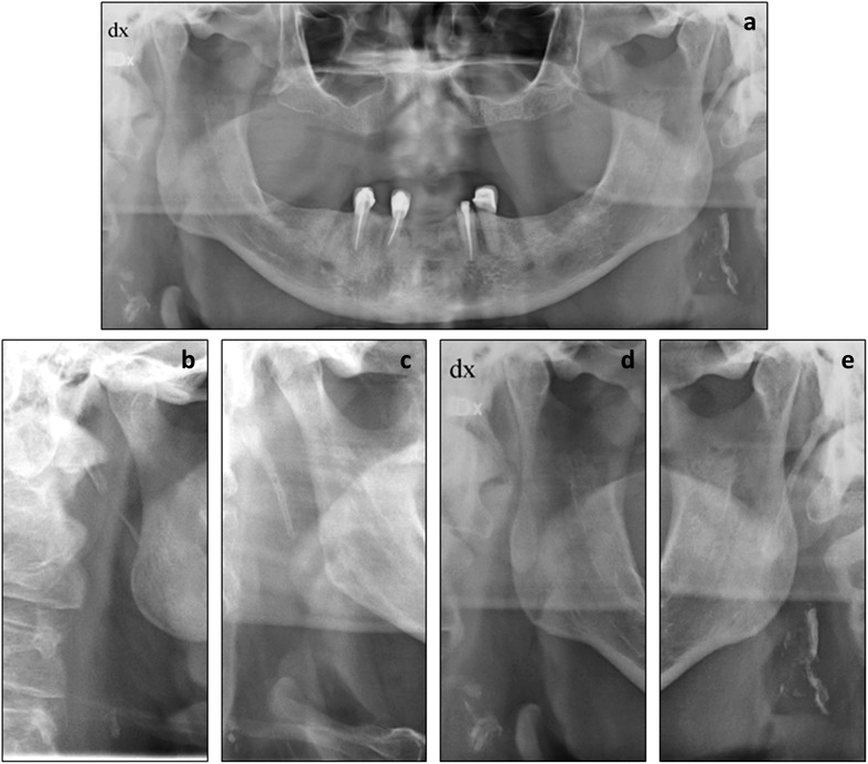 Panorâmica de paciente parcialmente edêntulo com calcificações lineares nos dois lados do pescoço, abaixo do ângulo da mandíbula, e quatro recortes ampliados mostrando calcificações única, dispersa e contornando o vaso.