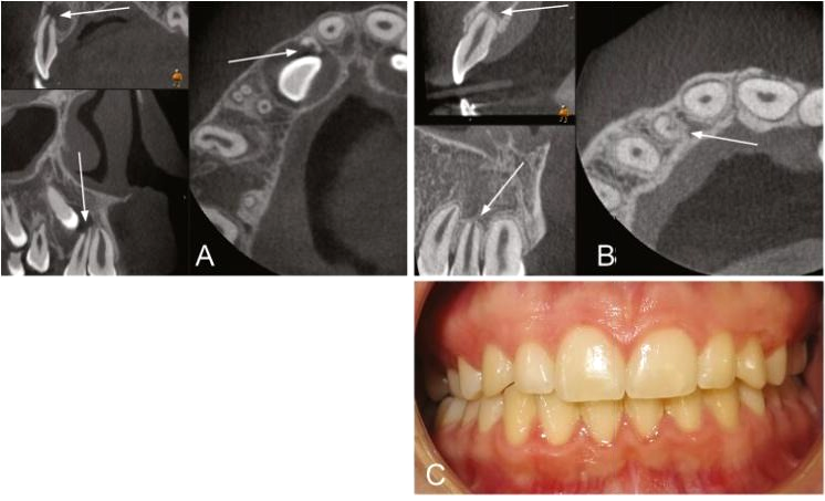 Cortes de tomografia mostrando reabsorção na raiz do incisivo lateral superior junto a um canino incluso, no diagnóstico e no controle anos depois, e foto clínica do sorriso no controle.