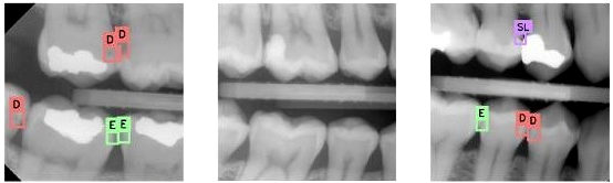 Três recortes de radiografias interproximais com lesões proximais marcadas: retângulos verdes com a letra E em lesões de esmalte, vermelhos com D em lesões de dentina e lilás com SL em lesão secundária sob restauração.