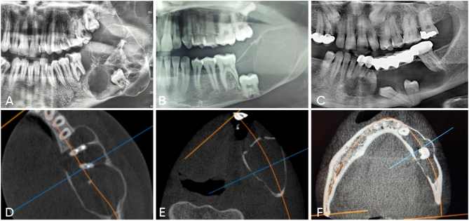 Três panorâmicas com lesões radiolúcidas na mandíbula, uma multilocular (ameloblastoma) e duas uniloculares (queratocisto e cisto dentígero), e três cortes axiais de tomografia com a cortical perfurada no ameloblastoma e íntegra no queratocisto e no cisto dentígero.