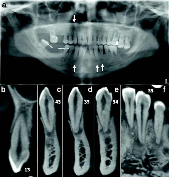 Panorâmica com várias áreas radiolúcidas nos ápices de dentes anteriores inferiores e de um canino superior, marcadas por setas, e cinco cortes de tomografia dos dentes 13, 43, 33 e 34 mostrando as lesões nos ápices.