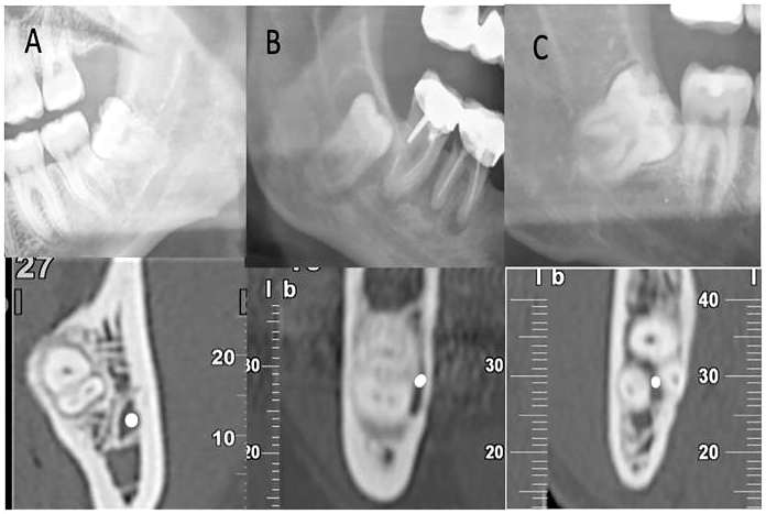 Três casos de terceiro molar inferior. Em cima, recortes de panorâmica com as raízes sobrepostas ao canal mandibular. Embaixo, cortes transversais de tomografia de cada caso, com um ponto branco marcando o canal.