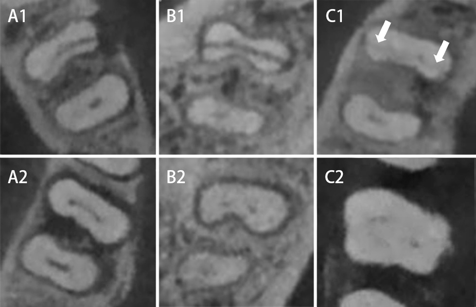 Seis cortes axiais de tomografia de molares inferiores: três dentes com fratura radicular vertical, com perda óssea em arco e uma linha de fratura sutil indicada por setas, e três dentes sem fratura com perdas ósseas parecidas.