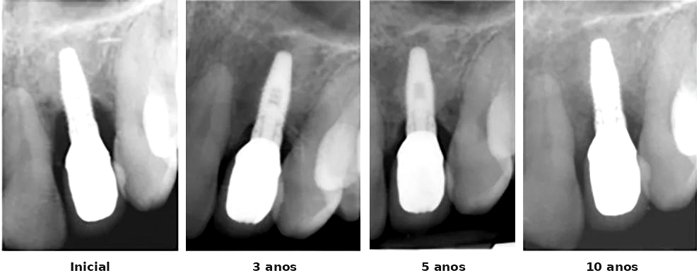 Radiografias periapicais de um implante: na inicial, defeito ósseo ao redor do implante; nos controles de 3, 5 e 10 anos, osso preenchendo o defeito.