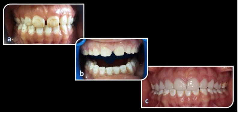 Três fotos clínicas de dentes anteriores com fluorose: antes do tratamento, após o preparo e com as facetas cerâmicas cimentadas.
