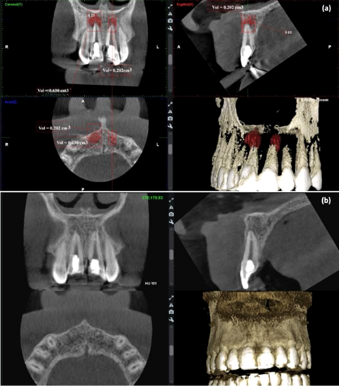 Cortes coronal, sagital e axial e reconstrução 3D de tomografia de incisivos centrais superiores. Em (a), lesões periapicais segmentadas em vermelho; em (b), após 12 meses, osso periapical reparado.