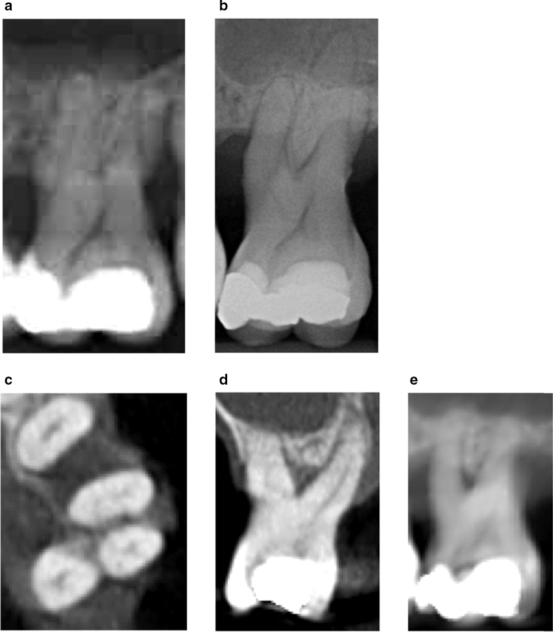 Molar superior com lesão de furca grau III: recorte ampliado de panorâmica, radiografia periapical e três cortes de tomografia (axial, coronal e sagital) mostrando a perda óssea entre as raízes.