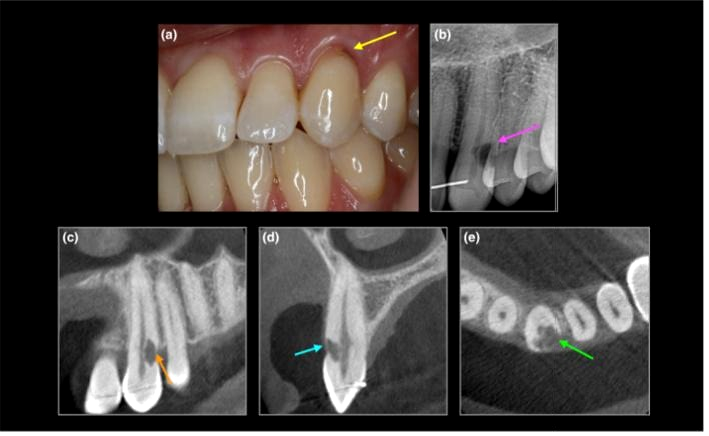 Canino superior com reabsorção cervical: foto clínica com cavitação junto à gengiva, radiografia periapical com radiolucidez cervical e três cortes de tomografia mostrando a lesão.
