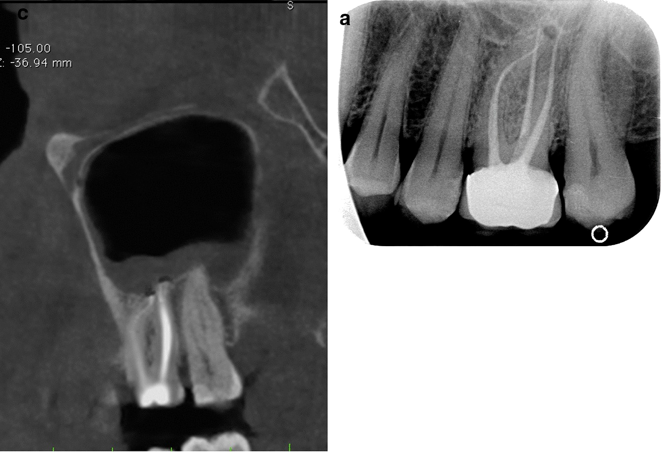 À esquerda, corte coronal de tomografia do seio maxilar com as raízes de um molar superior tratado projetadas no assoalho do seio e mucosa espessada sobre elas; à direita, radiografia periapical do mesmo dente com pequena lesão apical.