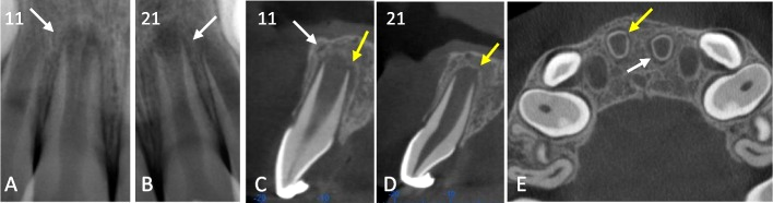 Duas radiografias periapicais e três cortes de tomografia de incisivos centrais superiores imaturos após trauma, com setas brancas nos achados visíveis nos dois exames e setas amarelas nos achados vistos só na tomografia.